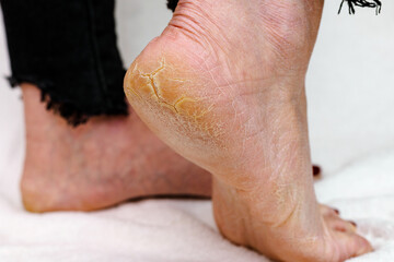 Dry and cracked soles of feet. Womans feet with dry heels, cracked skin.White background.