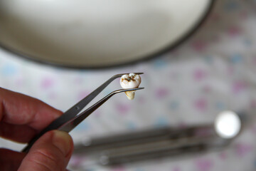 Extracted wisdom tooth in a tweezers