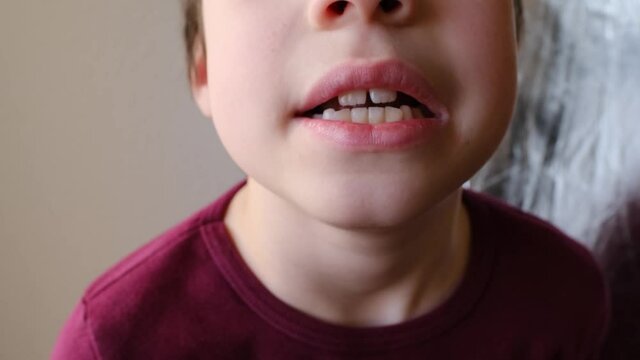 kid, child of 8 shows his teeth, concept of speech disorders, correction, frenum of tongue, methods of correctional developmental exercises