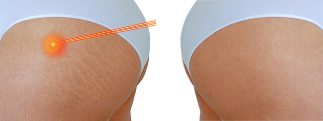 Image compare before and after Woman buttocks with stretch marks removal treatment,  with laser...
