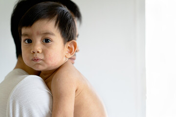 The parent is hugging a sickness asian little baby boy from viral infection skin rash, concept of healthcare, medical and skin problem from viral and hypersensitivity. - obrazy, fototapety, plakaty
