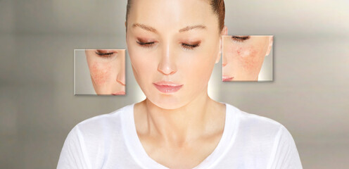 Rosacea,reducing the redness of enlarged blood vessels.