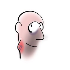 Man with lymph node tuberculosis in his neck