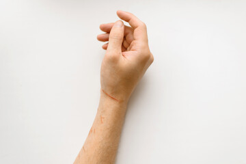 Scratched hand on a white background, top view. Skin scratches from a cat