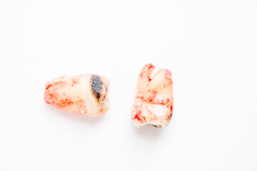 A close up two tooth with severe tooth decay also known as dental caries or cavities due to bad oral hygiene, isolated on white background