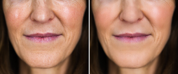 Anti Rejuvenation Wrinkles Lift Before