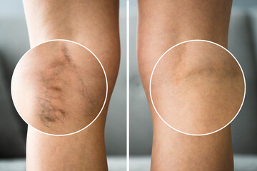 Before After Cellulite Inflammation Legs Treatment - obrazy, fototapety, plakaty