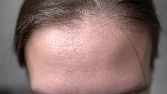 A woman's forehead wrinkles. The woman is surprised by raising her eyebrows. Horizontal wrinkles on the female forehead. Lump on the girl's face. Getting rid of facial wrinkles