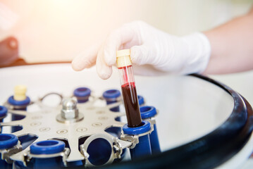 Platelet-Rich plasma preparation. Tube with blood in hands