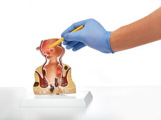 Rectum pathologies on an anatomical model, isolated on white. Treatment of rectal diseases,...