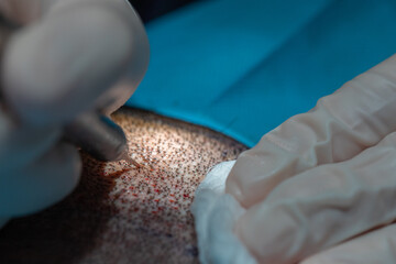 Hair Implantation Process, Closeup view of Scalp, Hair Seeding