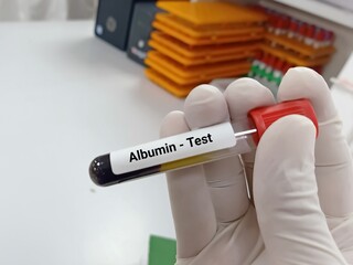 Biochemist or Lab Technologist holds Blood samples for Albumin test. Diagnosis of liver disease....
