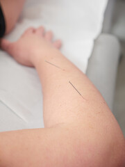Arm of a woman with acupuncture needles on