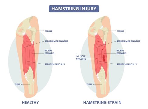 muscle leg knee biceps hip pulled tear injury grade pain running thigh examine cramp soccer football lacrosse pull sport athlete RICE torn skater player treat IT band first aid stretching back pelvis
