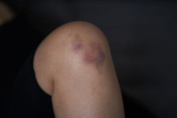 Fototapeta premium Close-up of a person massaging an injured knee joint. Bruise on the knee. Leg pain