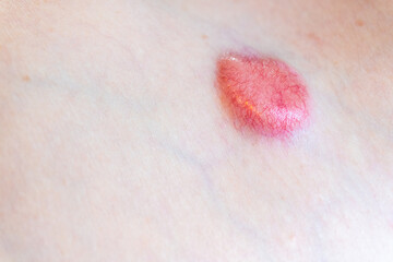 Raised dermatfibrosarcoma protuberans (DFSP, non-melanoma skin cancer) on chest shoulder having...