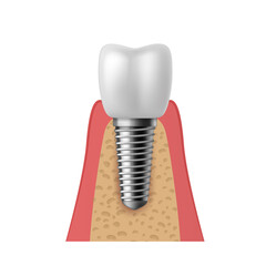 Realistic tooth implant. 3D denture orthodontic implantation teeth, implant structure pictorial models crown. Prosthetics in stomatology clinic concept vector isolated illustration