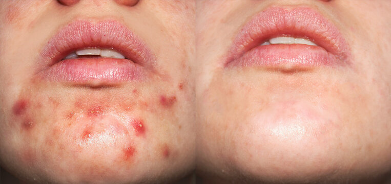 Photo with and without acne
Problem skin and beauty concept. Photos before and after treatment.