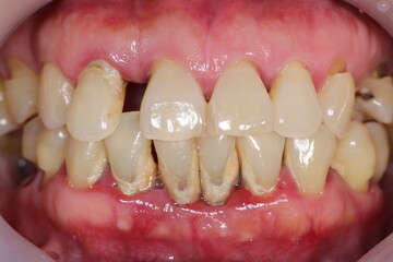 Periodontitis is often known as 'Gum Disease' and is a very common condition in which the gums and...