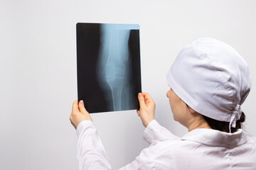 A doctor or radiologist holds an X-ray of a person's leg - knee, knee injury. Diagnosis of...