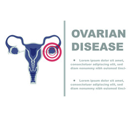 Ovarian diseases drawing, on white background.
