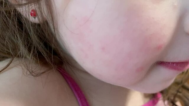 PIEL AT&Oacute;PICA EN LA CARA