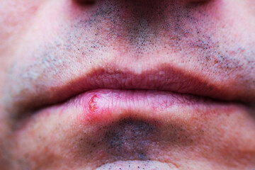 Herpes virus infection in man lips. Problem health care. Dermatological oral skin diseases.