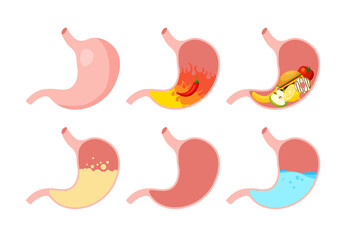 Healthy and unhealthy, empty and full human stomach in trendy flat style. Nutrition, stomach pain, bloating. Digestive system anatomy. Vector illustration isolated on white background.