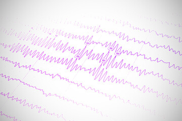 Results of electroencephalogram on paper, diagnostics of epilepsy