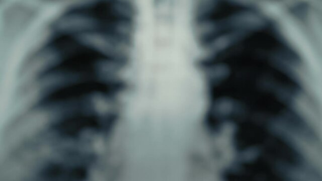 Radiological chest x-ray film, macro shot from blurred background. Asthma, COVID-19, coronavirus or pneumonia diagnostic concept.