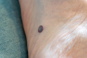 Human papillomavirus infection (HPV) of a plantar wart, treated with liquid nitrogen cryotherapy (wart freezing) as a medical treatment, showing the circular blood scab and the wart seed dying off