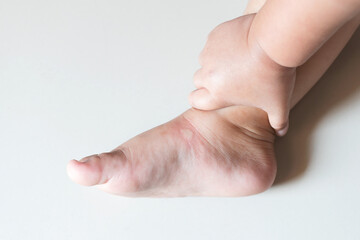 Skin swelling of mosquito bites on baby feet. Close-up
