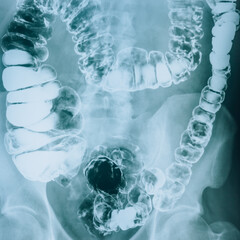 Bowel X-ray. Sick intestines. Intestinal examination.