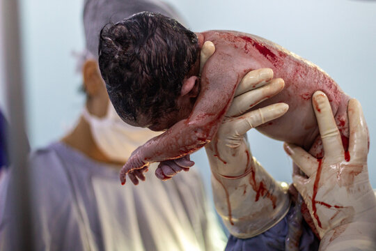 Uma cirurgia ces&aacute;ria mostrando um beb&ecirc; nascendo