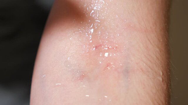 Close-up of hydrogen peroxide treatment of a scratch.