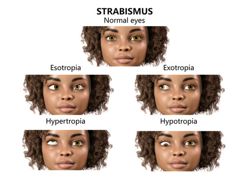 Strabismus in children, illustration