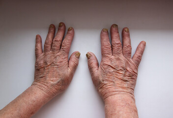hands of an elderly woman on a white surface. wrinkled hands. diseased nails