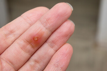 a purulent sore with redness and inflammation on the finger