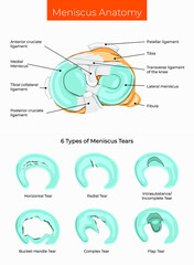 Vector illustration. Meniscus Anatomy and 6 Types of Meniscus Tears.