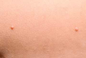 Detail of a molluscum contagiosum nodule produced by the Molluscipoxvirus virus on the skin of the...