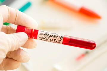 Hepatitis C blood test tube samples in laboratory, Hepatitis C vaccine