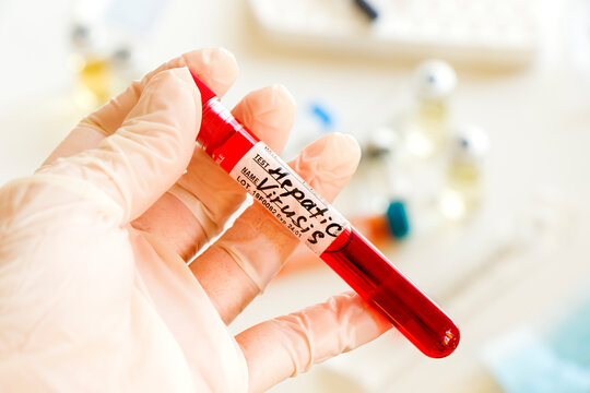 Hepatitis C Blood Test Tube Samples In Laboratory, Hepatitis C Vaccine