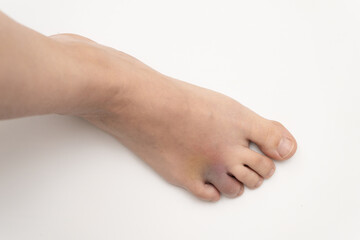 Bruise on the foot. Hematoma after injury to the ring toe of the left foot. Female injured limb on a white background.