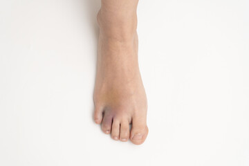 Bruise on the foot. Hematoma after injury to the ring toe of the left foot. Female injured limb on a white background.