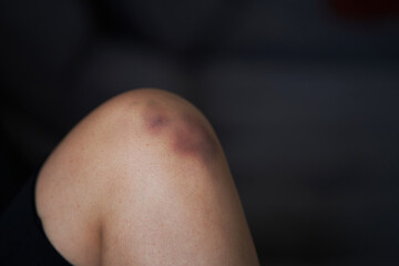 Close-up of a person massaging an injured knee joint. Bruise on the knee. Leg pain