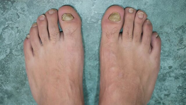 Young man barefoot fingers with sick onycho mycosis nails,dermatologic medical illness,health problem 