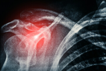 X-ray of shoulder, roentgen picture of human bones of skeleton and red spot as symbol of illness and pain.
