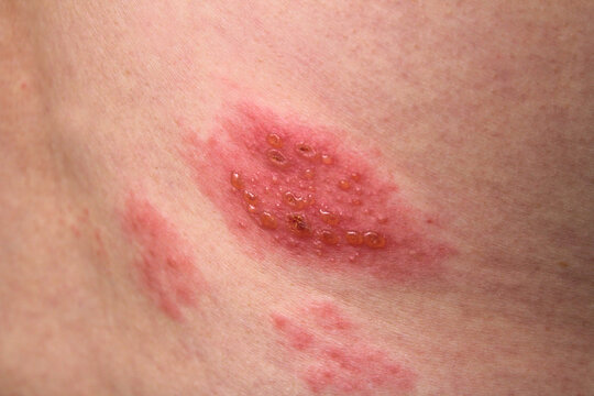 Herpes Zoster