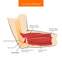 Vector illustration. Tennis Elbow Area of Pain. Elbow joint. 