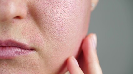 Macro skin with enlarged pores. Allergic reaction, peeling, care for problem skin.